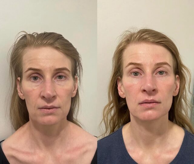 Vau! 😍Ihan mahtavia tuloksia Yin your skin kosmeettisella gua shalla. Tässä on asiakkaalle tehty vain kaksi hoitoa ja kokonaisvaltainen ilmeen kirkastuminen on huomattava.💆🏼♀️ YYS kosmeettisessa gua shassa yhdistyy sidekudoshieronta, lymfahoito, sekä perinteinen gua sha.💆🏼♀️ Tällä hoidolla monet ovat saaneet apua mm. bruksismiin, sekä kasvojen lihasten kireyteen, juonteisiin ja ihon kimmoisuuteen, erilaisiin ihotulehduksiin, sekä ihon värin ja rakenteen tasoittumiseen. Hoito on myös syvärentouttava ja hermostoa rauhoittava, täydellinen kiireiseen arkeen.Hoitokokonaisuus ja sarjahoitojen pituus rakentuu aina yksilöllisesti asiakkaiden tarpeiden ja toiveiden mukaan. Ota rohkeasti yhteyttä, jos olet kiinnostunut hoidosta, teen mielelläni konsultaatiota.🤍 Sanna