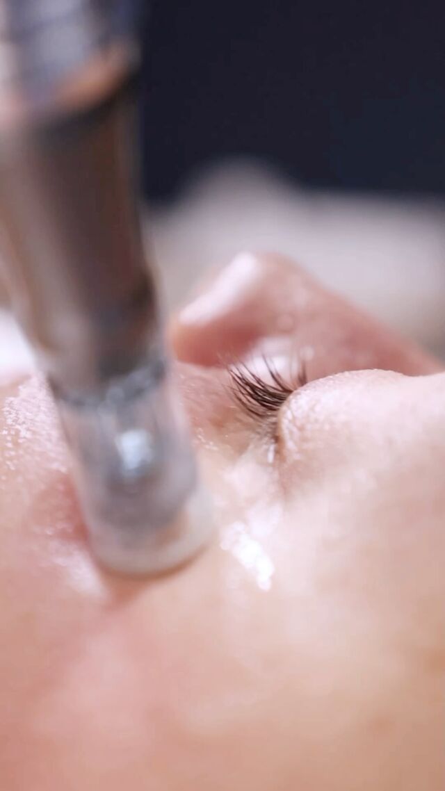 Meidän yksi suosituimmista kasvohoidoista - BTB13 mikroneulaus!Mikroneulaus on ei-kirurginen hoito, jolla muodostetaan steriilien neulojen avulla mikrokanavia ihoon. Hoito stimuloi ihon luonnollista paranemisprosessia, kollageenin ja elastiinin tuotantoa. Patentoitu BTB13-yhdiste uudistaa ihosoluja ja hoito auttaa tekemään ihosta tasaisemman, kiinteämmän ja vahvemman.Sarjahoidolla hienoja tuloksia mm. arpien ja juonteiden tasoittamiseen. Yksittäinen mikroneulaus on loistava hoito syväkosteuttamaan ja vahvistamaan ihoa.Yleisin kysytty kysymys on sattuuko hoito? Ei missään nimessä! 😊 Mikroneulauslaitteen avulla saamme säädettyä neulan syvyyttä ja katsomme jokaisen asiakkaan ihon yksilöllisesti ja tarkkaan.Jos haluat tietää hoidosta lisää, kysy ihmeessä. Teemme mielellämme konsultaatioita ennen sarjahoidon aloitusta. 🤍