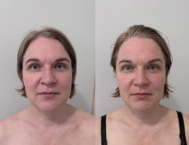 Kevään ja alkukesän olen päässyt tekemään hurjan paljon kosmeettista gua shaa.Tässä asiakkaani kolmen kerran tulos, ihan MIELETÖN! 😍Asiakkaani sanoin ”väsynyt kanssakulkija”, mutta eipä ole enään! Ihana freesaus ilmeeseen kesäksi. 🥰Laita viestiä, jos kosmeettinen gua sha hoitona kiinnostaisi. Konsultoin mielelläni. Minulla sarjahoitoihin kuuluu lisäksi oma gua sha väline kotihoitoon, sekä laajat videot gua shan opetteluun.🤍 Sanna